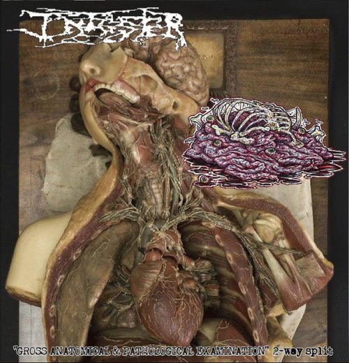 Botched Anastomosis J-Pouch : Gross Anatomical & Pathological Examination 2-Way Split